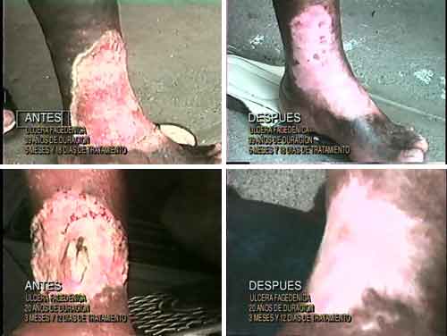 Ulcera Gangrenada